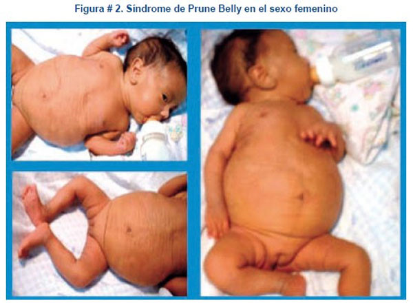 Hội chứng mất cơ bụng - Hình ảnh minh họa